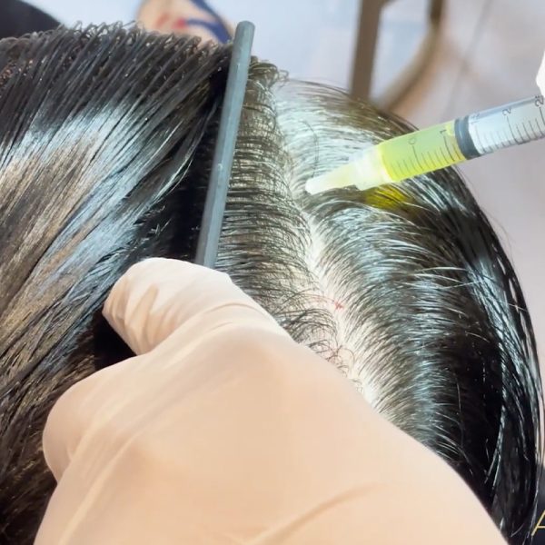 Aivee PRP Hair Restoration