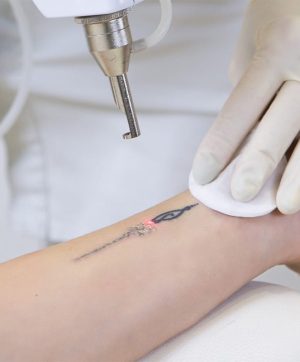 Tattoo Removal